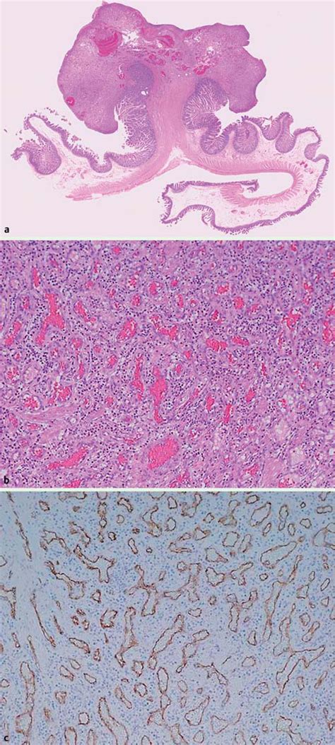 Histologic Examination Of The Resected Tumor Showing A The Appearance