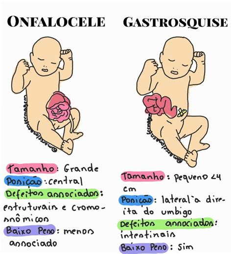 Marcelo Alves On Instagram Onfalocele X Gastrosquise