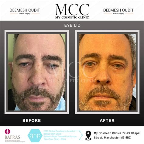 Eyelid Reduction (Blepharoplasty) | Expert Eyelid Surgery