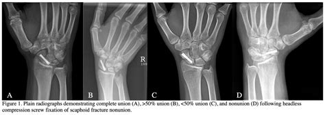 Percutaneous Screw Fixation Of Scaphoid Nonunions Without Bone Grafting