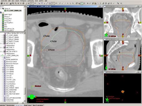 Figure 1 From Image Guided Radiation Therapy For Muscle Invasive Carcinoma Of The Urinary