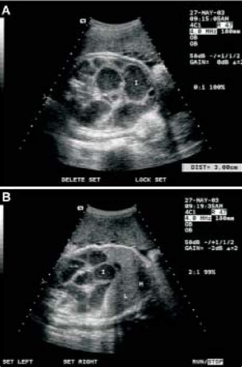 Figure From Prenatal Sonographic Findings In A Fetus With Congenital