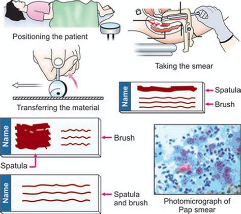 Pap Smear Procedure Steps