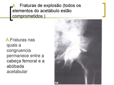 Luxa Es Do Quadril E Fraturas Da Cabe A Do F Mur Ppt Carregar