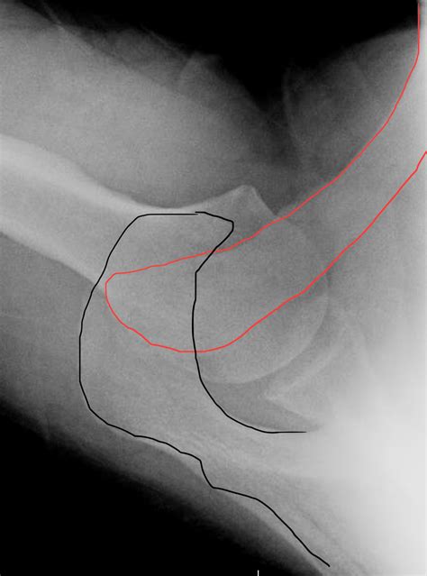 Shoulder and Elbow Surgery: Chronic AC joint separation ...