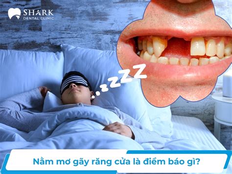 Giải Mã Nằm Mơ Gãy Răng Cửa Có điềm Gì Tốt Hay Xấu