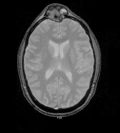 Langerhans Cell Histiocytosis Image Radiopaedia Org