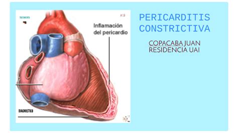 Pericarditis Constrictiva By Juan Carlos Copacaba On Prezi