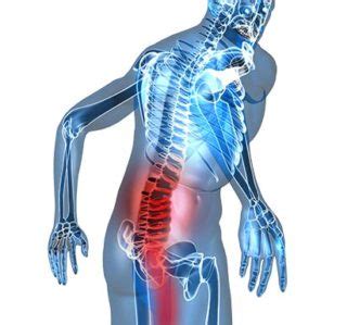 Lumbar Radiculopathy - ShimSpine