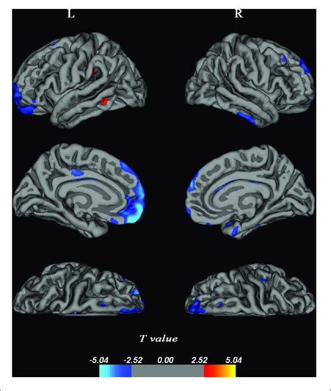 | Changes in cortical thickness over 4 years. Cortical thickness was ...