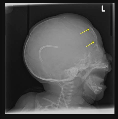 Solution to Unknown Case # 8 – Luckenschadel Skull versus Copper Beaten ...