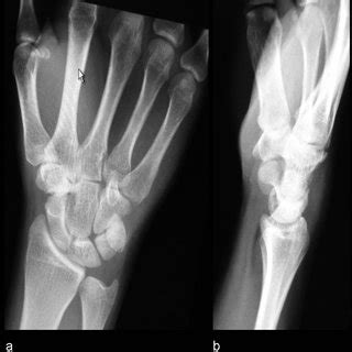 Postero Anterior A And Lateral B Radiographs Of The Right Wrist Two