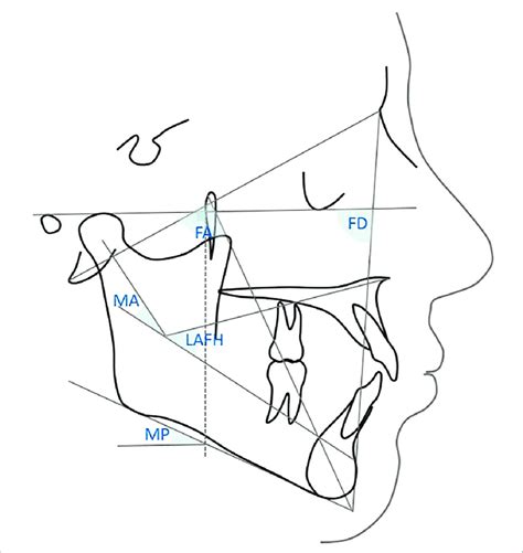 Angles For Vert Index Fa Facial Axis Angle Between The Lines Download Scientific Diagram