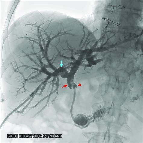 Percutaneous Transhepatic Cholangiography Ptc And Internal External