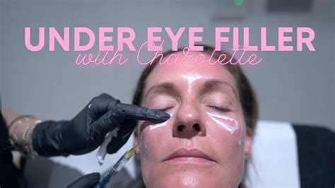 Under Eye Filler Treatment With Dr Nina Bal 💕 Under Eyes Circles