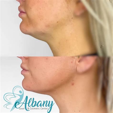 Belkyra Injection Case No 1385 Albany Cosmetic And Laser Centre In