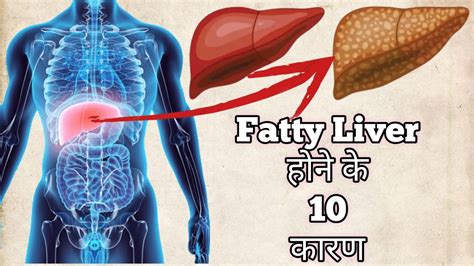 Strictly Avoid These 10 Things If You Have Fatty Liver Liver Disease