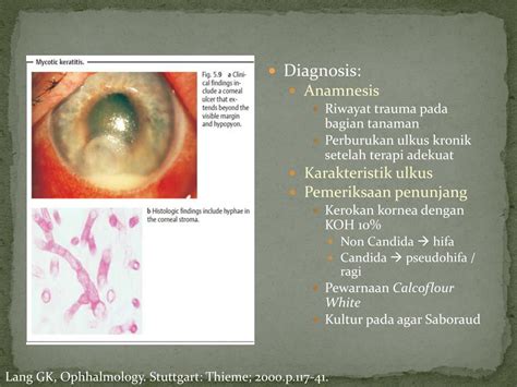 Ppt Keratitis Dan Ulkus Kornea Powerpoint Presentation Free Download