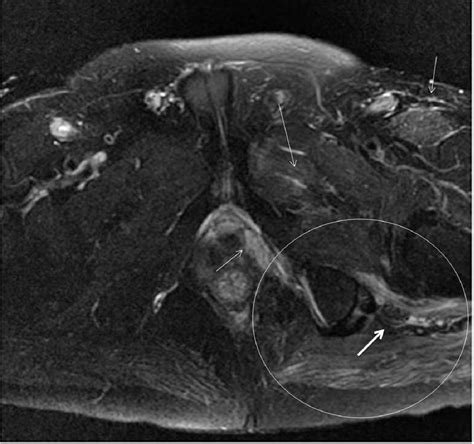 Figure 2 from Deep Gluteal Syndrome: anatomy, imaging and management of ...