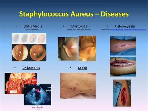 PPT MRSA Methicillin Resistant Staphylococcus Aureus PowerPoint