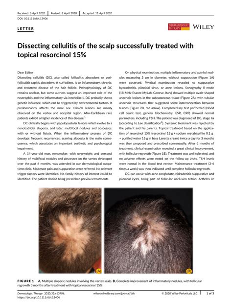 Dissecting Cellulitis Of The Scalp Successfully Treated With Topical Resorcinol 15 Request Pdf