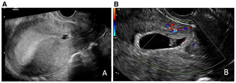 Cesarean Scar Ectopic Pregnancy Nuances In Diagnosis And Treatment