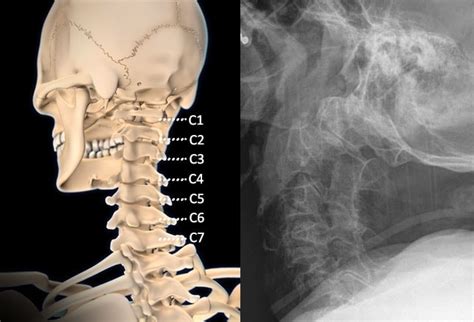 Interpretations Of The C Spine On Plain Radiography