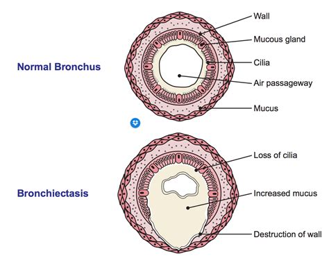 Bronchiectasis — Dr Claire Ellender