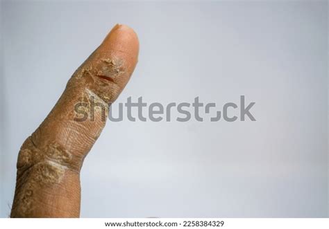 Dermatological Issue Dry Scaly Itchy Skin Stock Photo 2258384329 ...