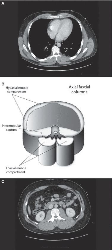 The thoracolumbar fascia: anatomy, function and clinical considerations ...