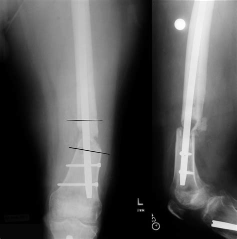 Nonunion Femur Case Dr Mark Brinker Houston Orthopedic Surgeon