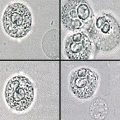 Epithelial Cells In Urine Microscopy