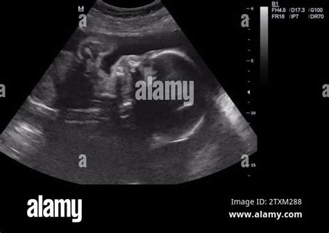 Ultrasound of pregnant woman in 6 month Stock Video Footage - Alamy