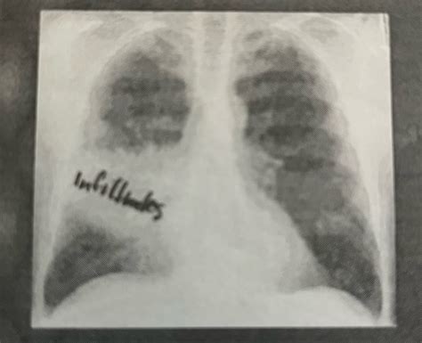 NeoPeds X Rays Flashcards Quizlet