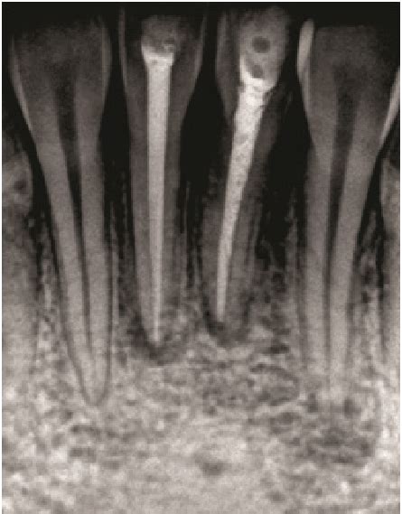 Radiograph Revealing Periapical Radiolucency With Mandibular Left