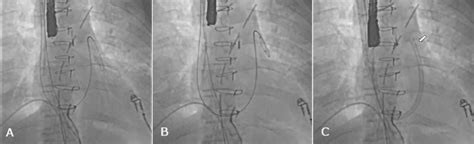 Percutaneous Rvad With The Protek Duo For Severe Right Ventricular