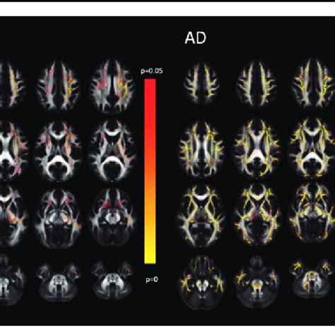 Diffusion Tensor Imaging Dti Of Mild Traumatic Brain Injury Mtbi