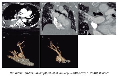 Percutaneous Treatment Of Post Traumatic Pulmonary Artery Pseudoaneurysm