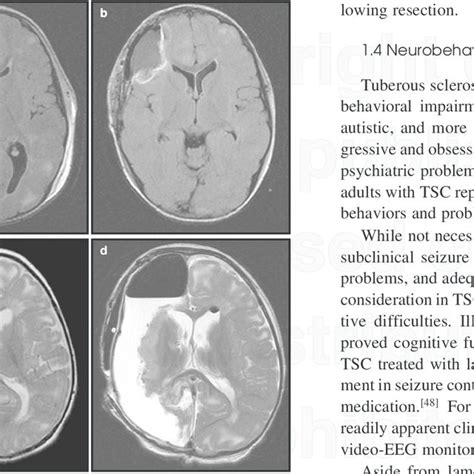 Lymphangioleiomyomatosis Lam In Tuberous Sclerosis Complex