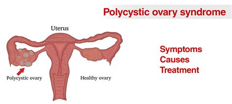 Polycystic Ovary Syndrome Symptoms Causes Treatment