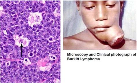 Non Hodgkins Lymphomas Flashcards Quizlet