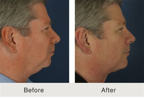 Chin Augmentation Implant Recovery | Carolina Facial Plastics