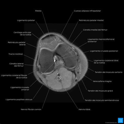 Cómo leer una RM de rodilla normal Kenhub