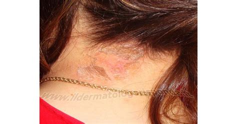 Scalp Eczema Remedies - SkinshareSG