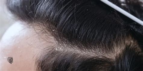 How To Get Rid Of Dandruff 10 Easy Tips For It Ahs India