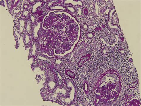 Ajkd Atlas Of Renal Pathology Proliferative Glomerulonephritis With Monoclonal Immunoglobulin