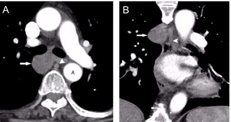 Rare Cause Of A Posterior Mediastinal Mass Diagnosed At Endobronchial Ultrasound Bmj Case Reports