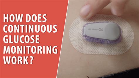 How Does Continuous Glucose Monitoring Work