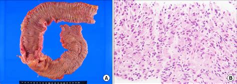 Figure 1 From Recurrent Primary Signet Ring Cell Cancer Of The Colon At Anastomosis Site After