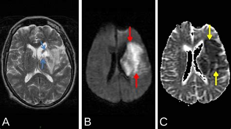 Left Mca Infarct With Hyperdense Mca Sign